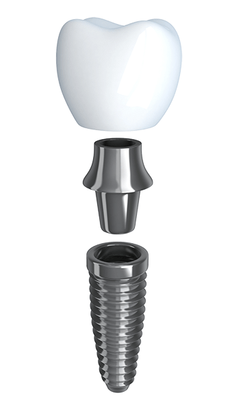 implante-dental